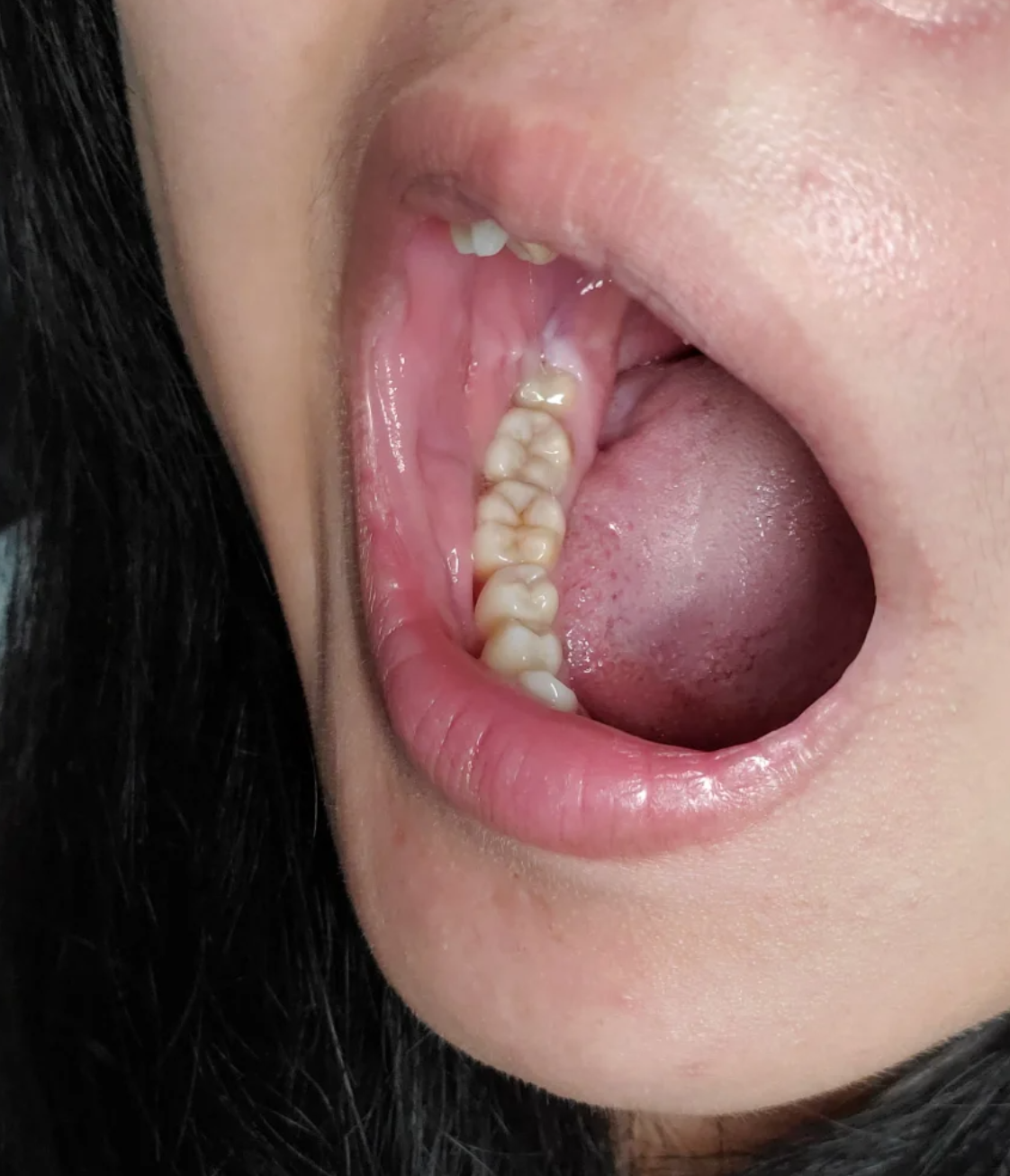 智齿通常在18岁左右开始生长,完全萌出大概需要半年时间,之后就会