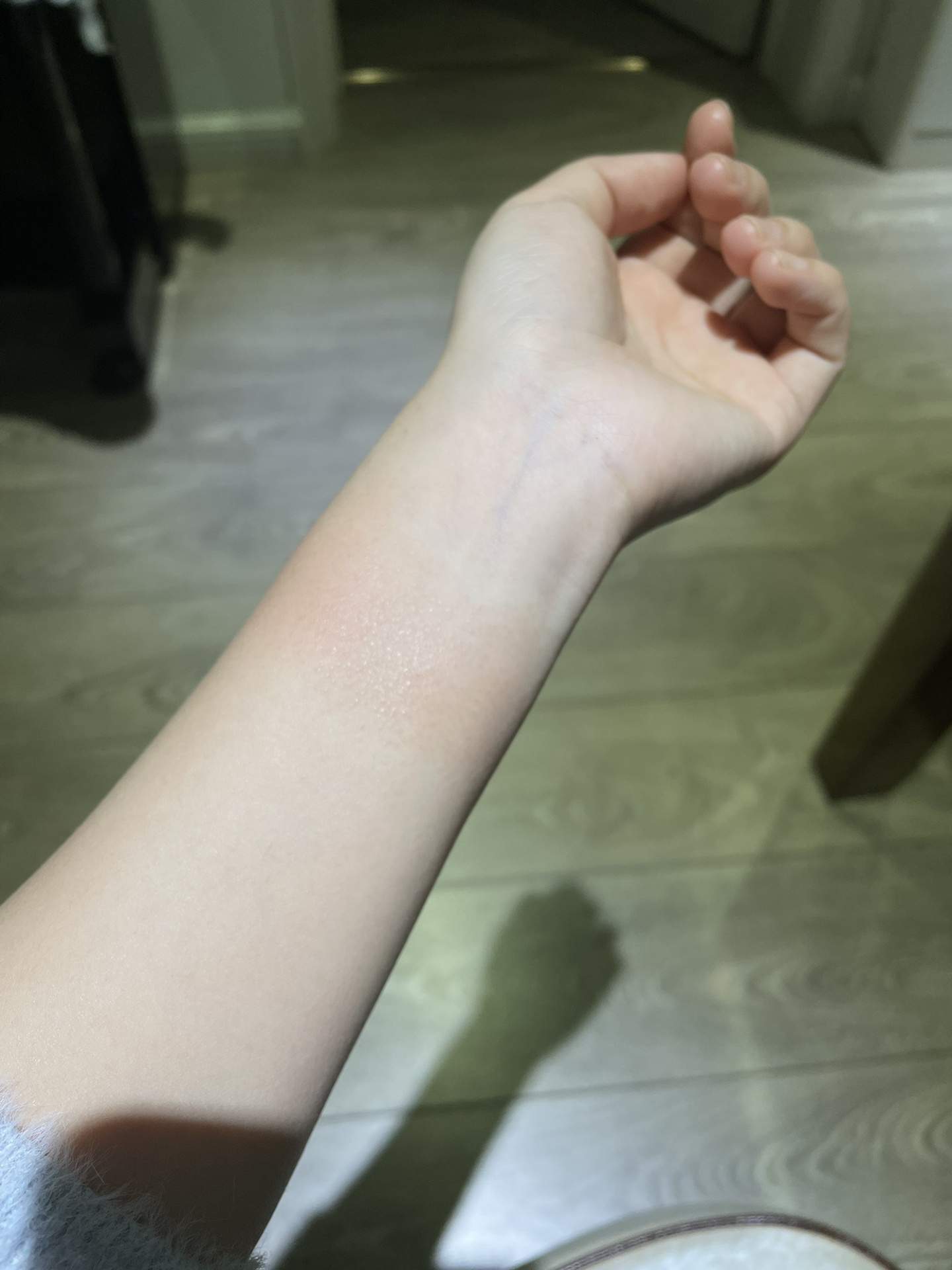 小米手环7腕带过敏?