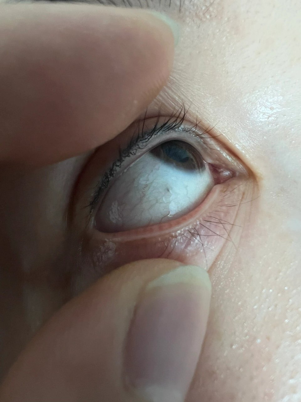 眼睛有个小凸起黑点是什么 家人们,眼球上这个小黑点是什么