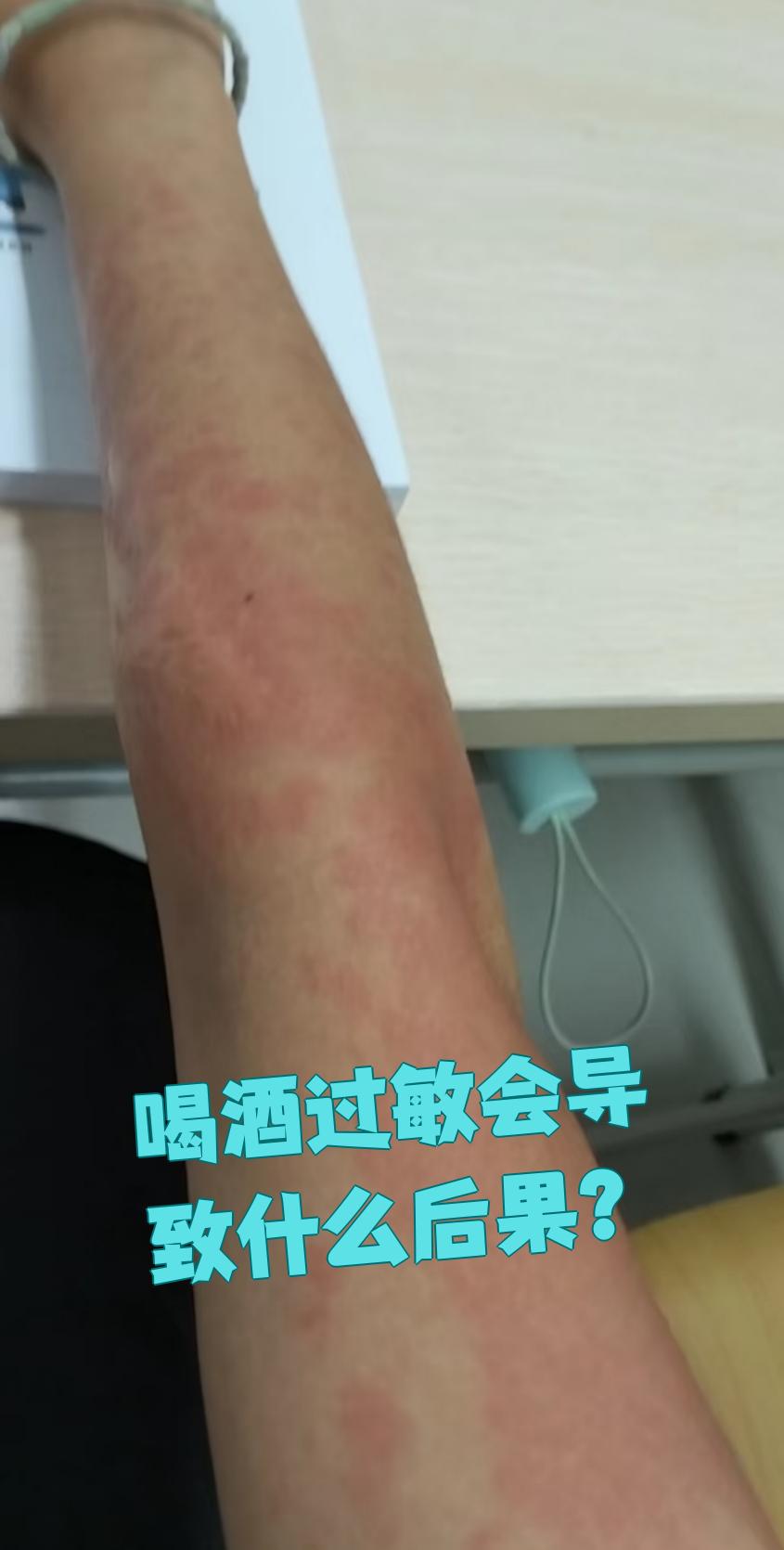 喝酒过敏在医学上叫酒精过敏症,主要是接触酒精或含酒精食物后引发