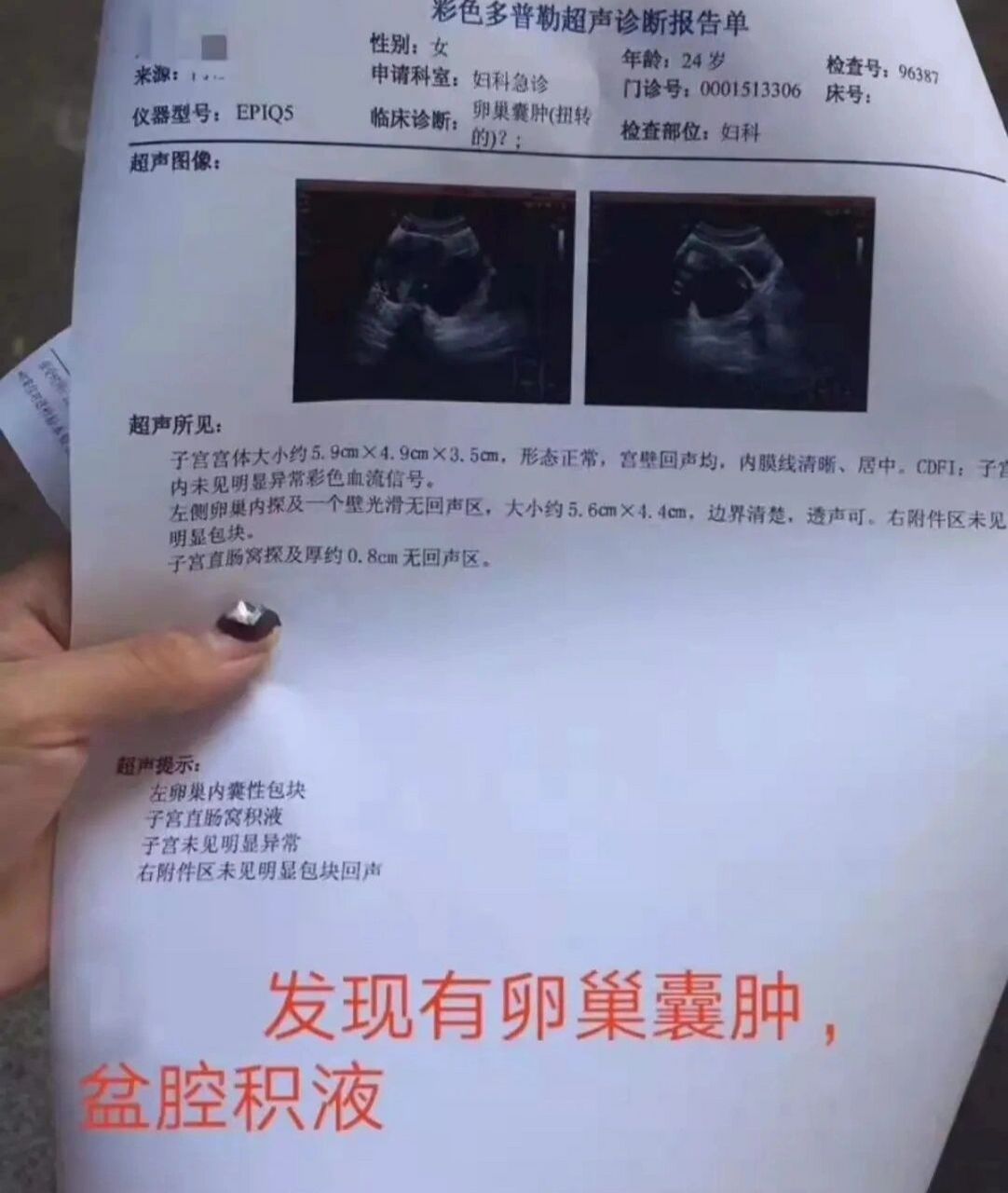 怎么看懂b超单子上的卵巢囊肿?