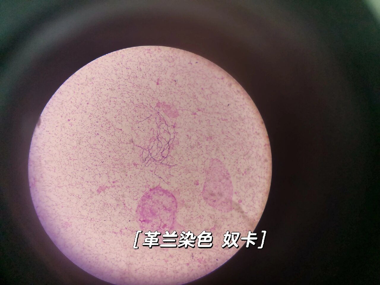 微生物日常—奴卡菌(诺卡菌) 周末值班偶见一标本革兰染色为革兰阳性