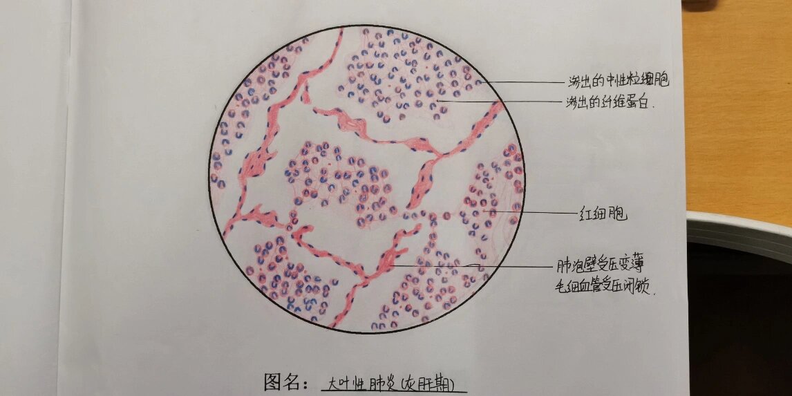 病理切片红蓝铅94 片名:大叶性肺炎(灰肝期) 材料:肺 染色:he 倍数