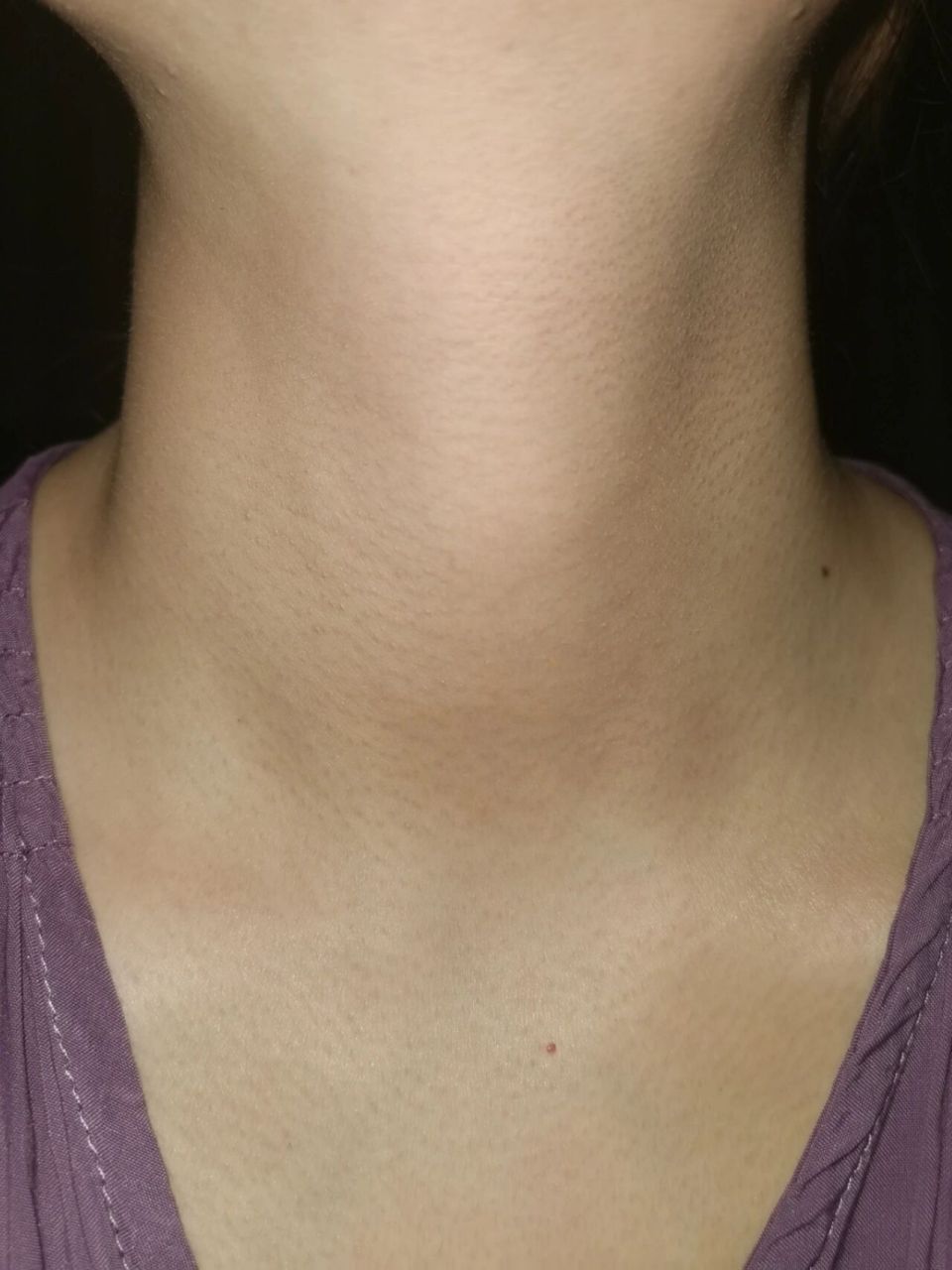 脖子上鸡皮肤 没太注意什么时候长的 密密麻麻真的跟鸡皮一样腻歪死了