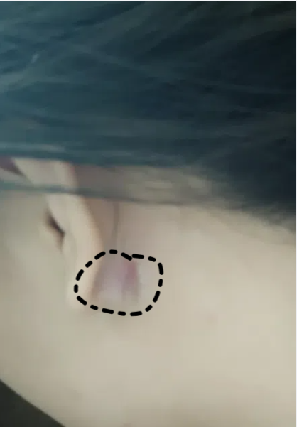 耳垂后面摸到一个小圆疙瘩,常见的原因有两种:皮脂腺囊肿和毛囊炎