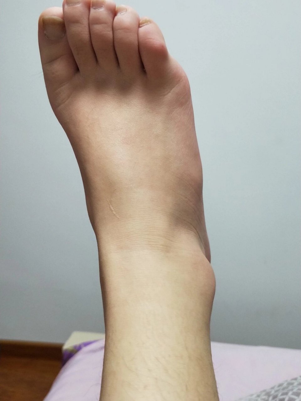 右脚第五跖骨骨折第82天