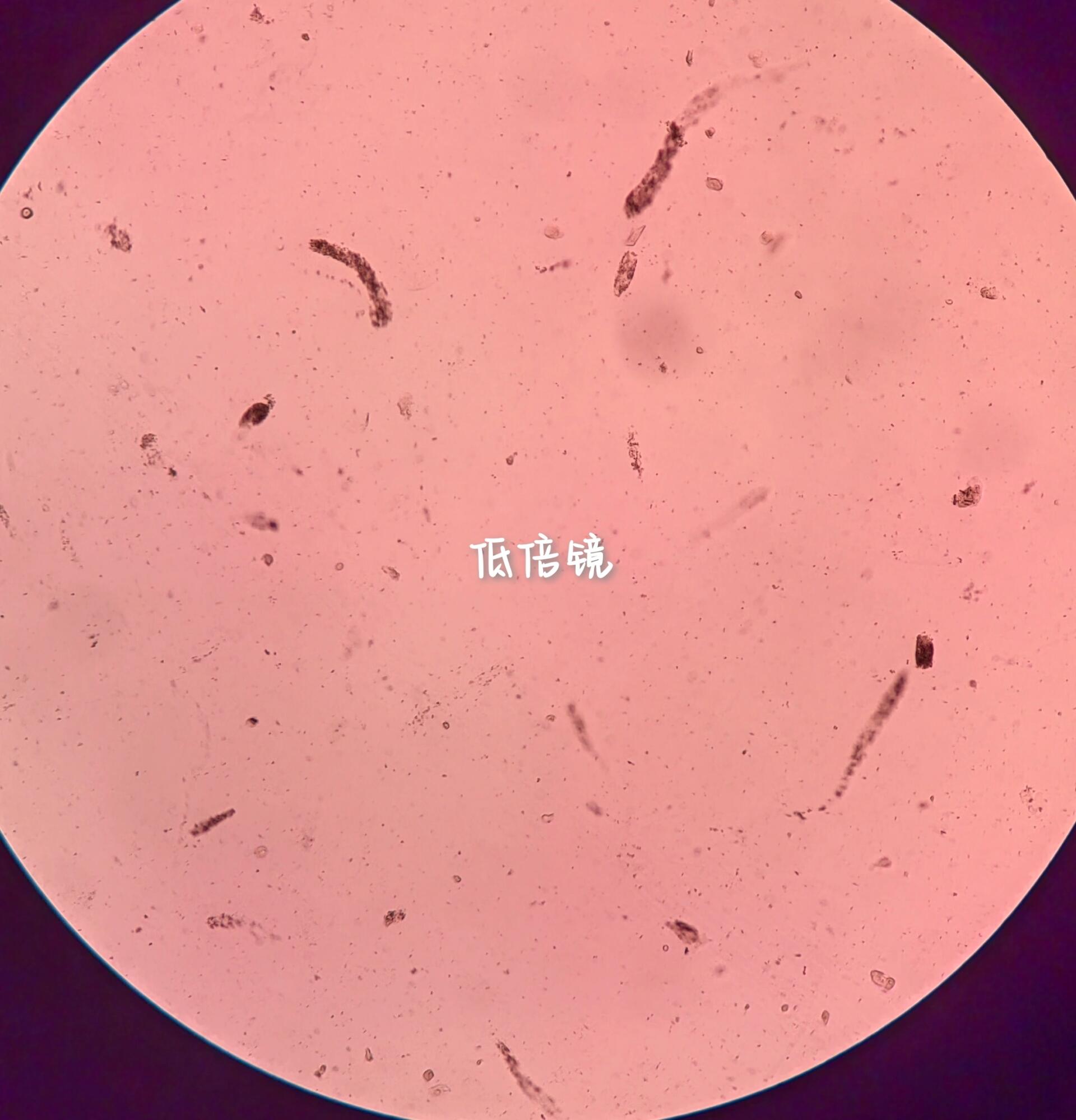 尿液检验第三篇:尿液中典型颗粒管型 8715尿液管型是蛋白质,碎片