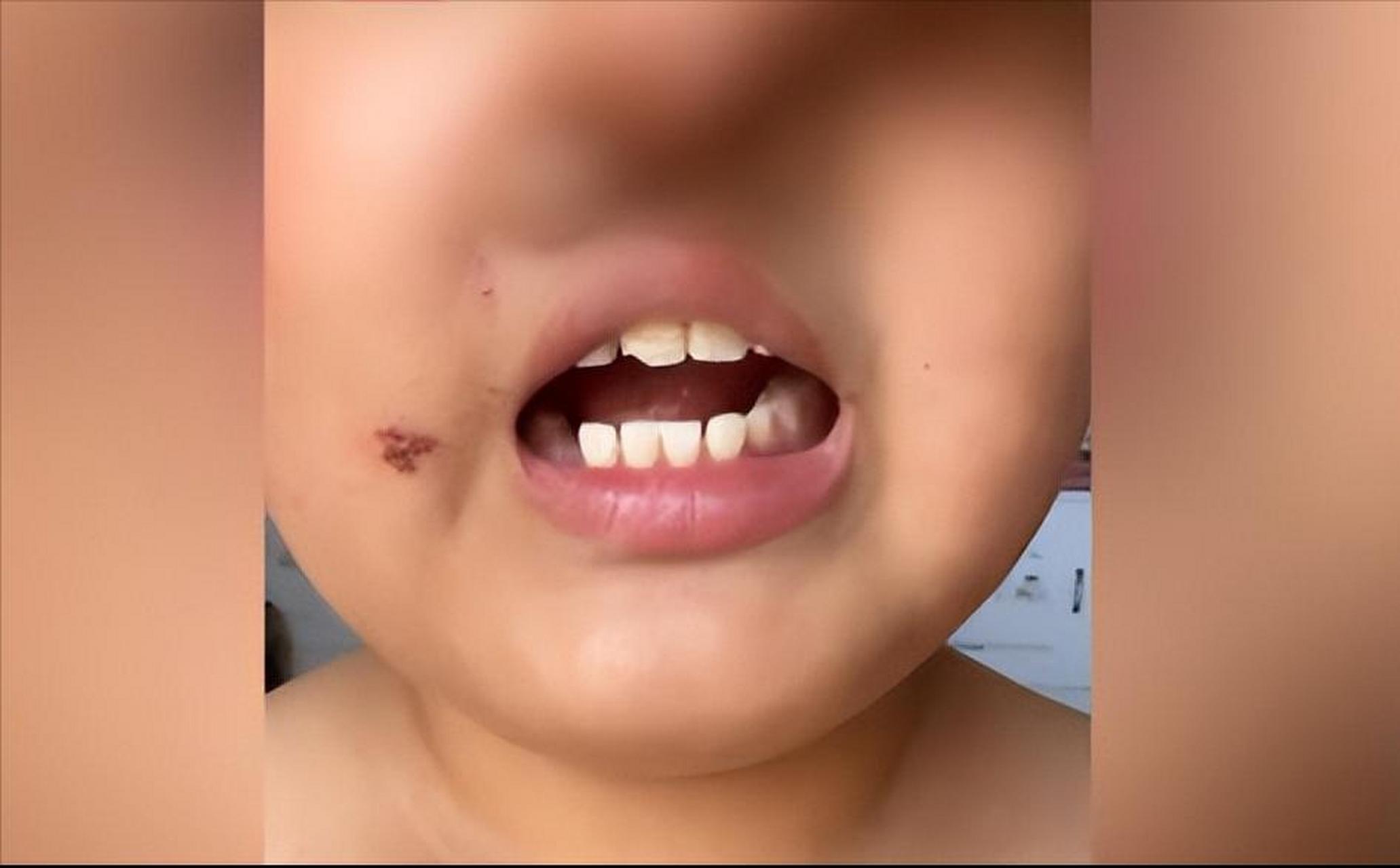 【小学生称被班主任虐待"拿针扎磕掉牙" 学校:教育