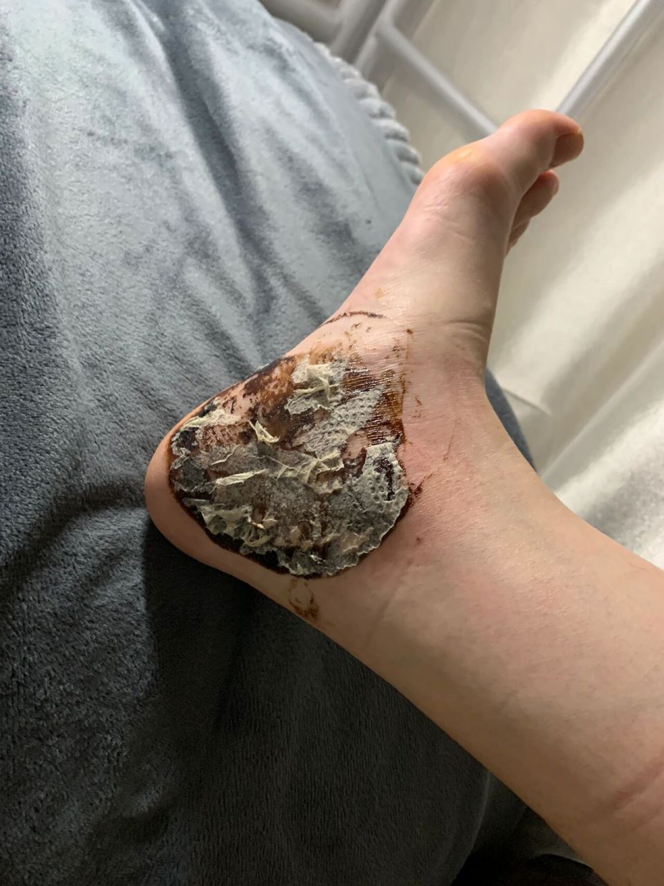 狗皮膏药除不掉 妈妈给的膏药说是很厉害的偏方,贴上三小时痒的不行