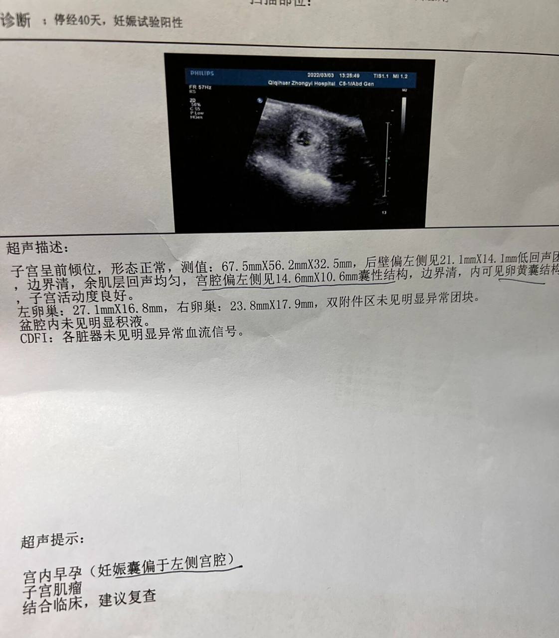 孕五周 6小插曲,孕囊偏左 今天五周776复查血值,排除宫外孕,血值都