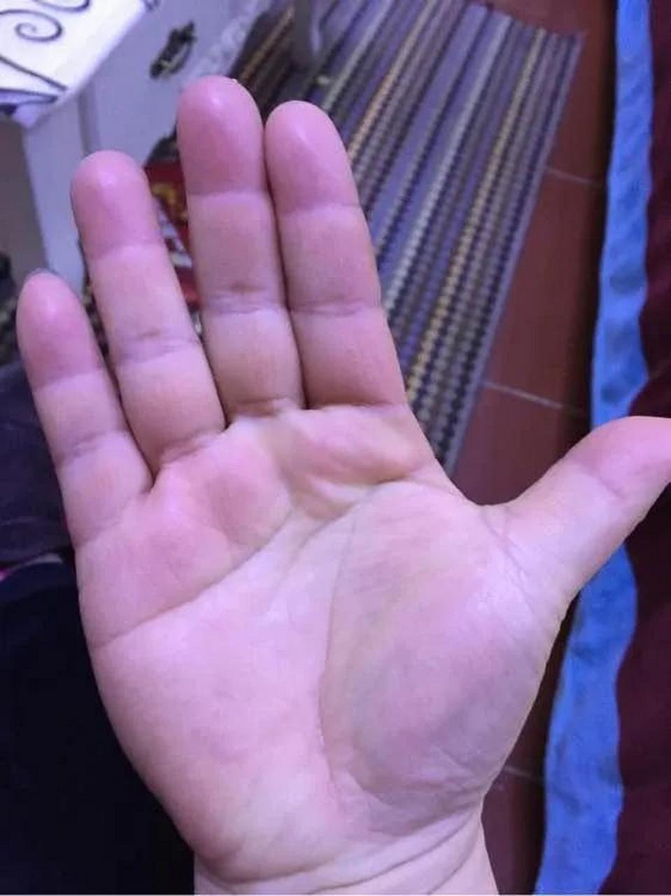 但有的人手掌无论是翻还是覆,都是无名指比食指长,要么无名指比