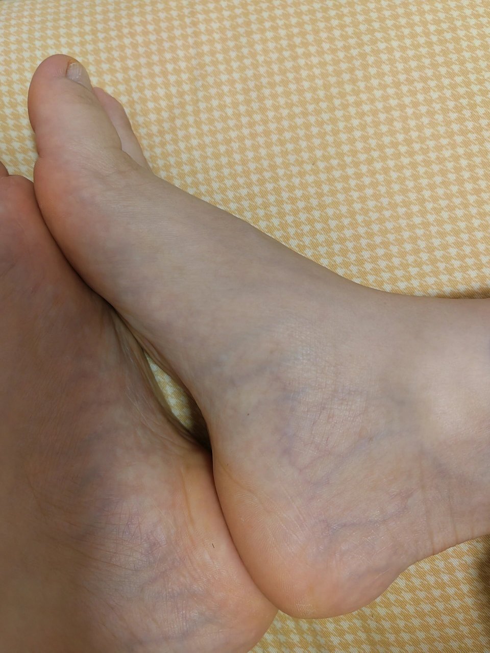 脚上突然多了好多毛细血管,各位大神帮我看看