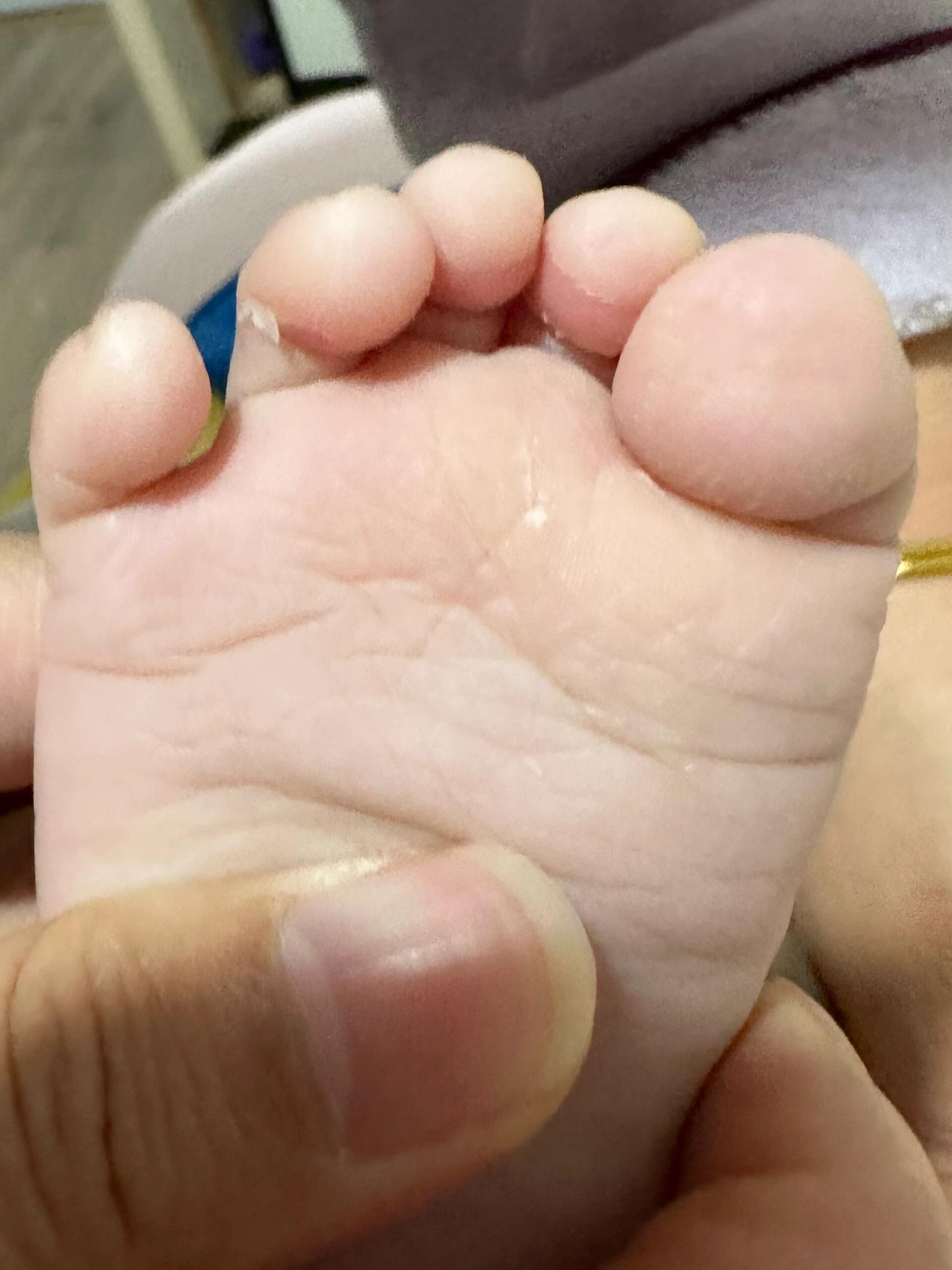 请问这是不是掌跖角化症?