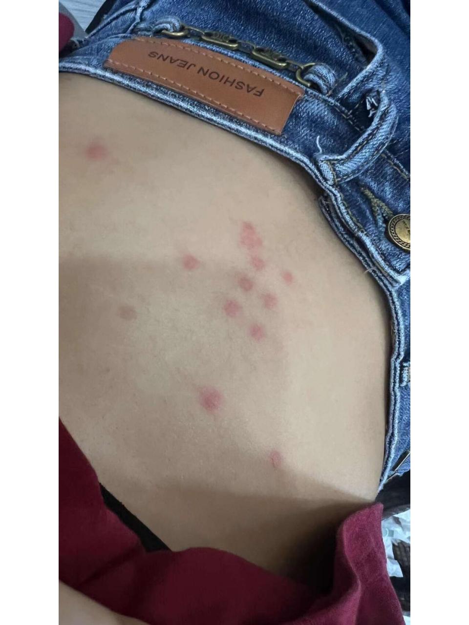 形状和外观:跳蚤咬伤的皮肤会出现红色的丘疹,这种丘疹可能略微高于