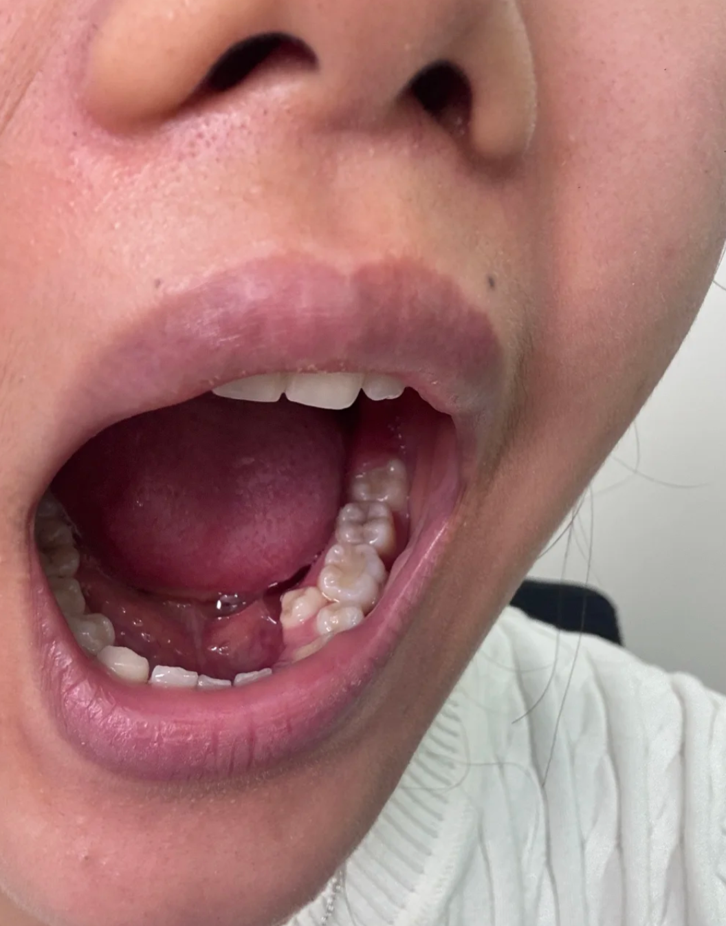 大牙外侧又长了个牙齿,这种情况最常见的原因是智齿或多生牙