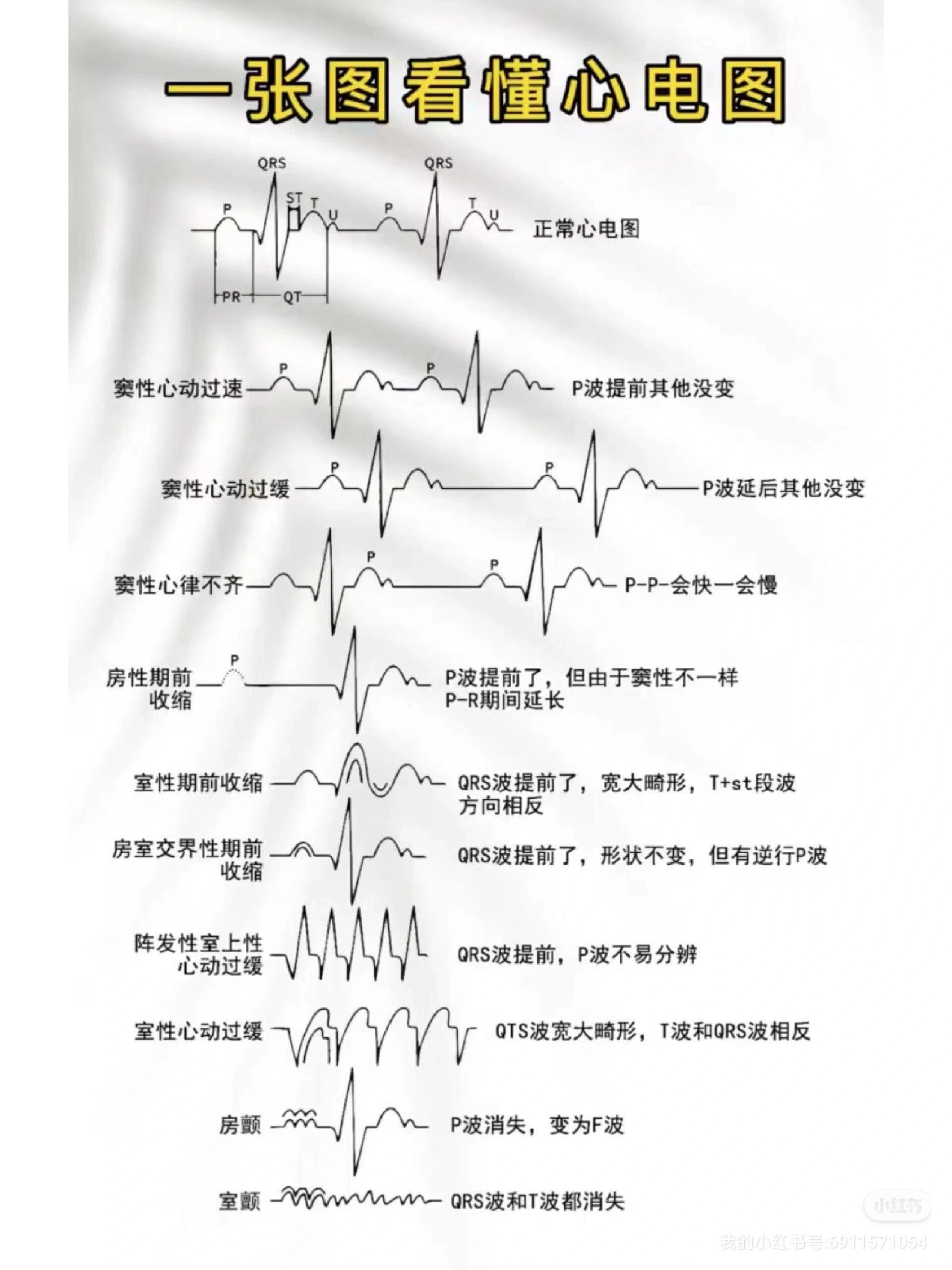 窦性心律不齐图解图片