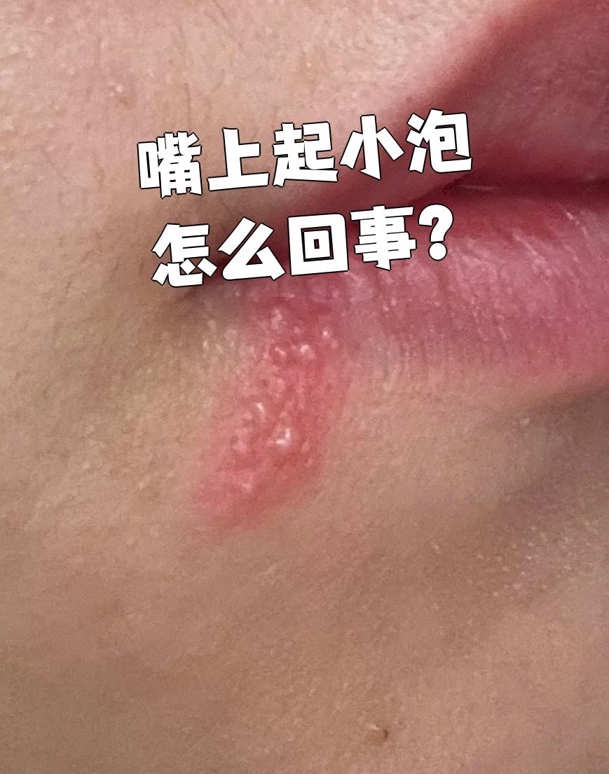 嘴上起小泡最常见的原因有干燥,食物过敏,接触性皮炎,口腔疱疹和