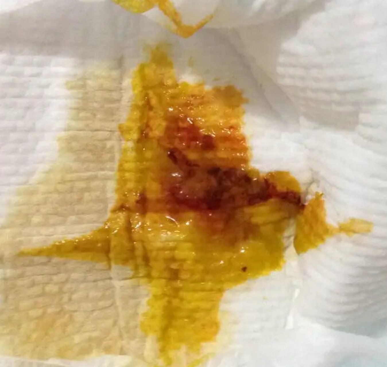 大便隐血有差别,肠黏膜脱落好分辨 宝妈发大便照片咨询宝宝大便情况