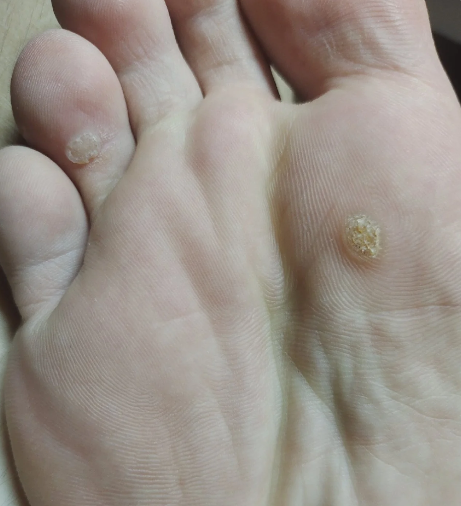 这种病主要长在脚底,属于寻常疣的一种,和性接触没有关系