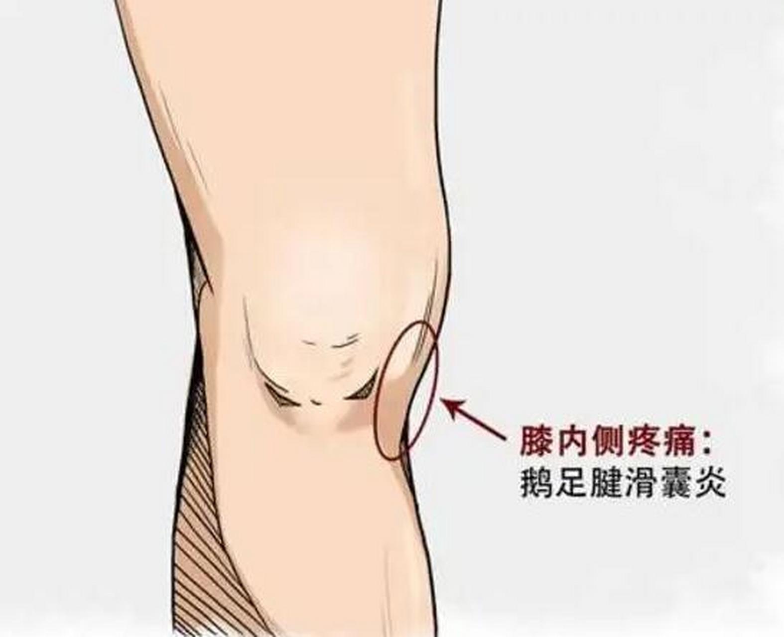 膝关节疼痛9个原因 1,膝关节正前方隆起的地方疼痛,是胫骨结节骨骺炎