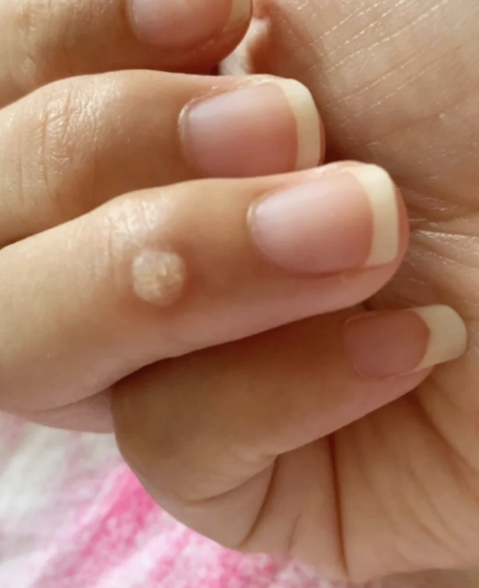 食指一侧出现硬疙瘩常见原因包括胼胝,鸡眼和痛风,不同情况处理方法
