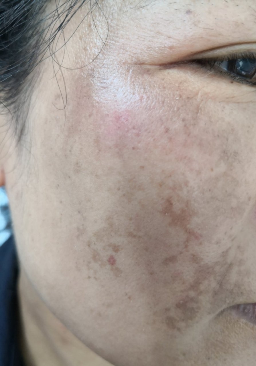 面部黄褐斑.经过一段时间的治疗后效果不错.逐渐变好中#美容#