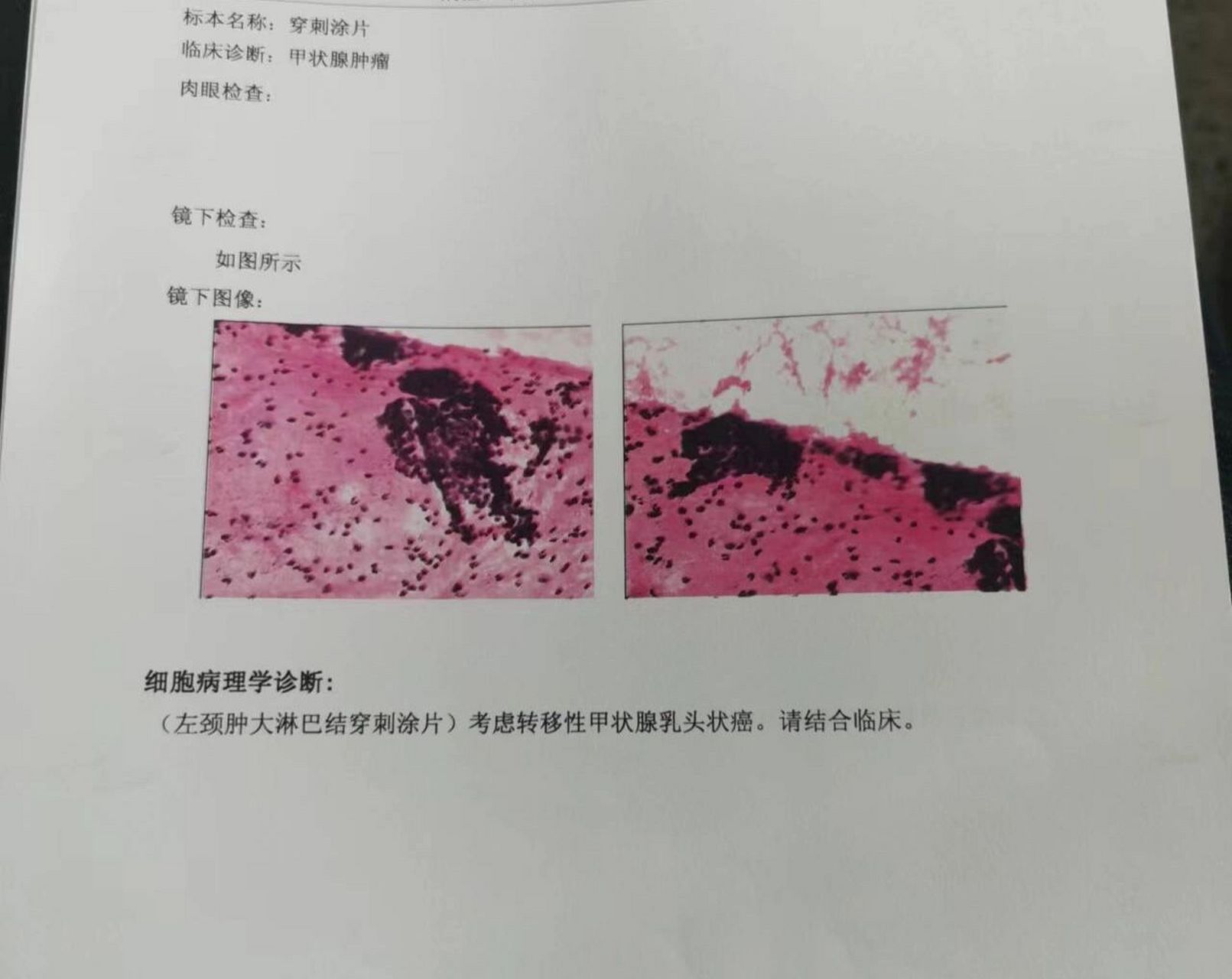 甲状腺癌之穿刺确诊 今天拿到了穿刺结果,毫无悬念,确诊乳头状癌!