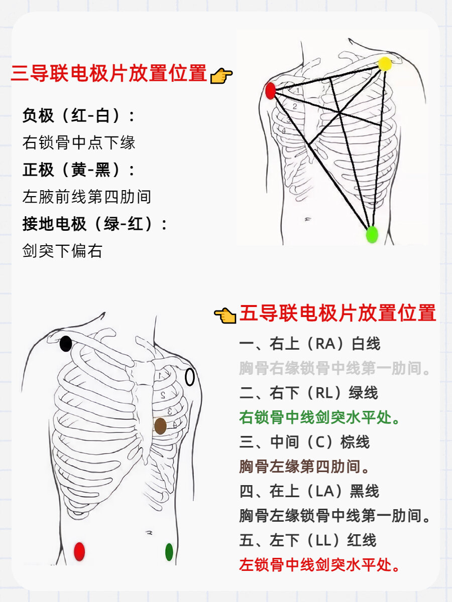 心电监护仪怎么看,一图就能看懂