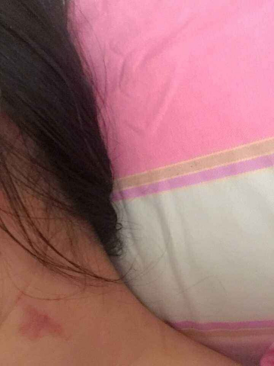 去吻痕(草莓印)最快的偏方 吻痕是情侣间因为爱意浓厚,导致意乱情迷所