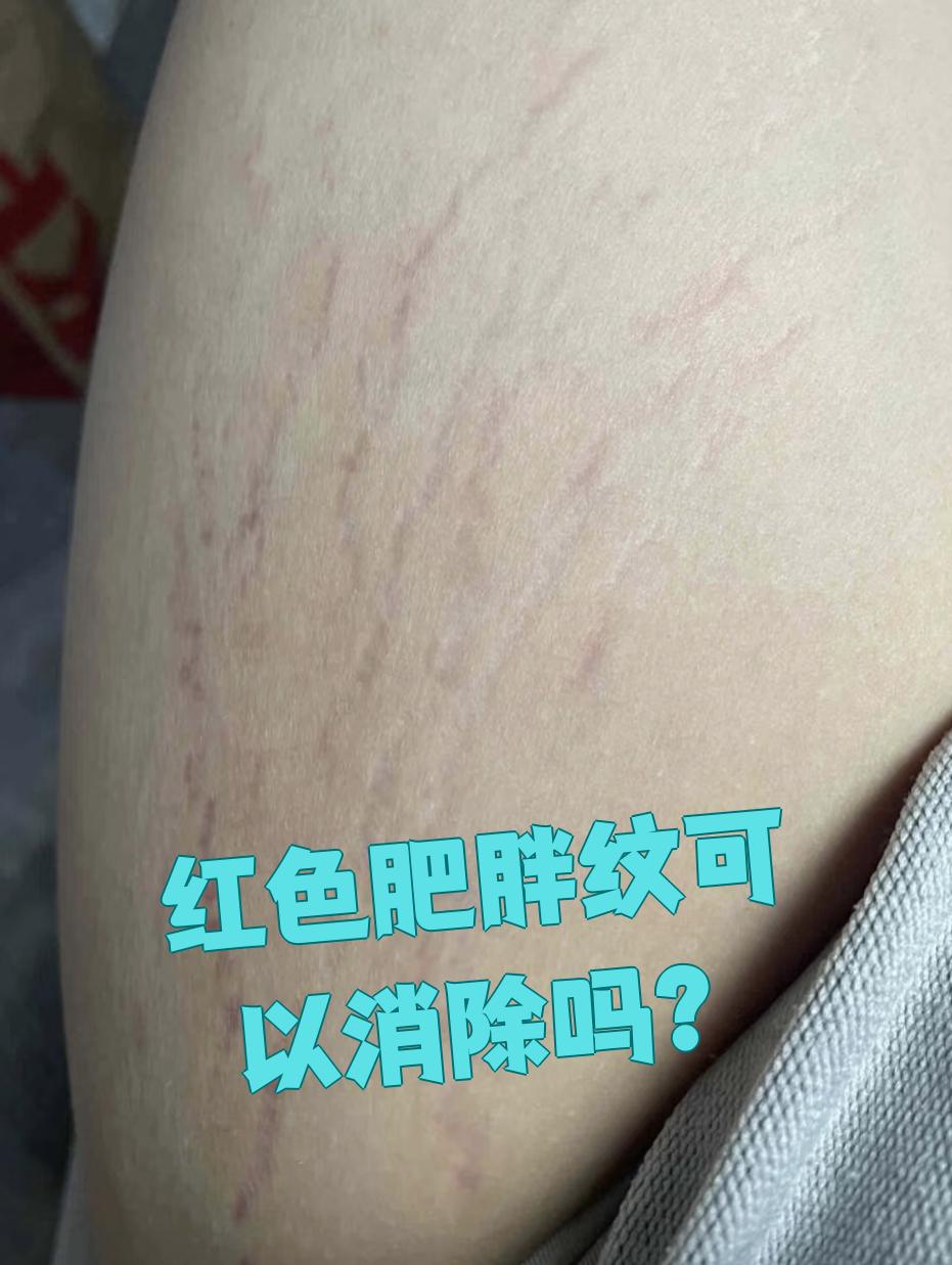红色肥胖纹能去掉吗?