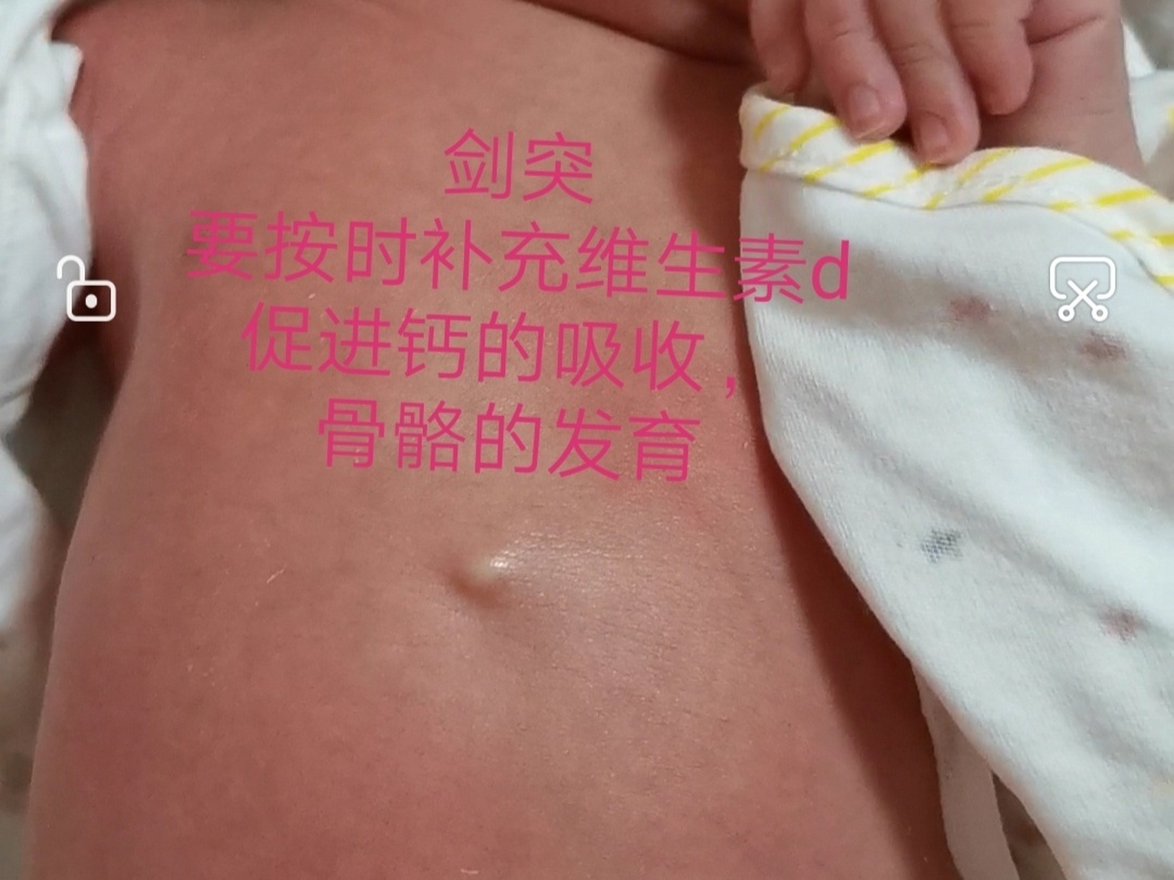 新生儿剑突 新生儿的剑突突出,有可能是跟以下原因有关:1,孩子腹部的