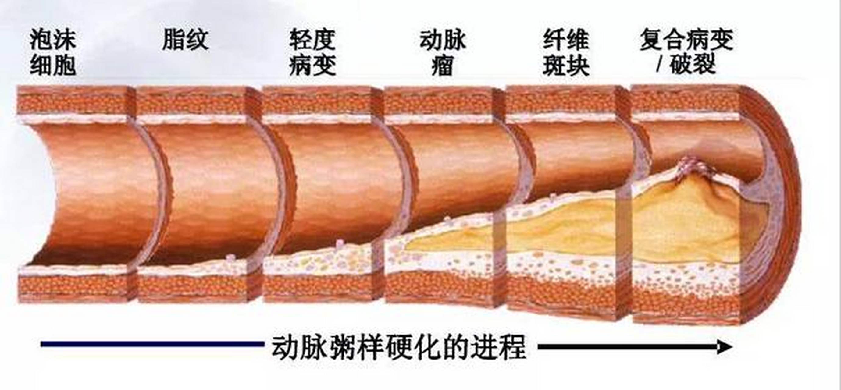 不同地方的动脉出现粥样硬化会有哪些症状表现?