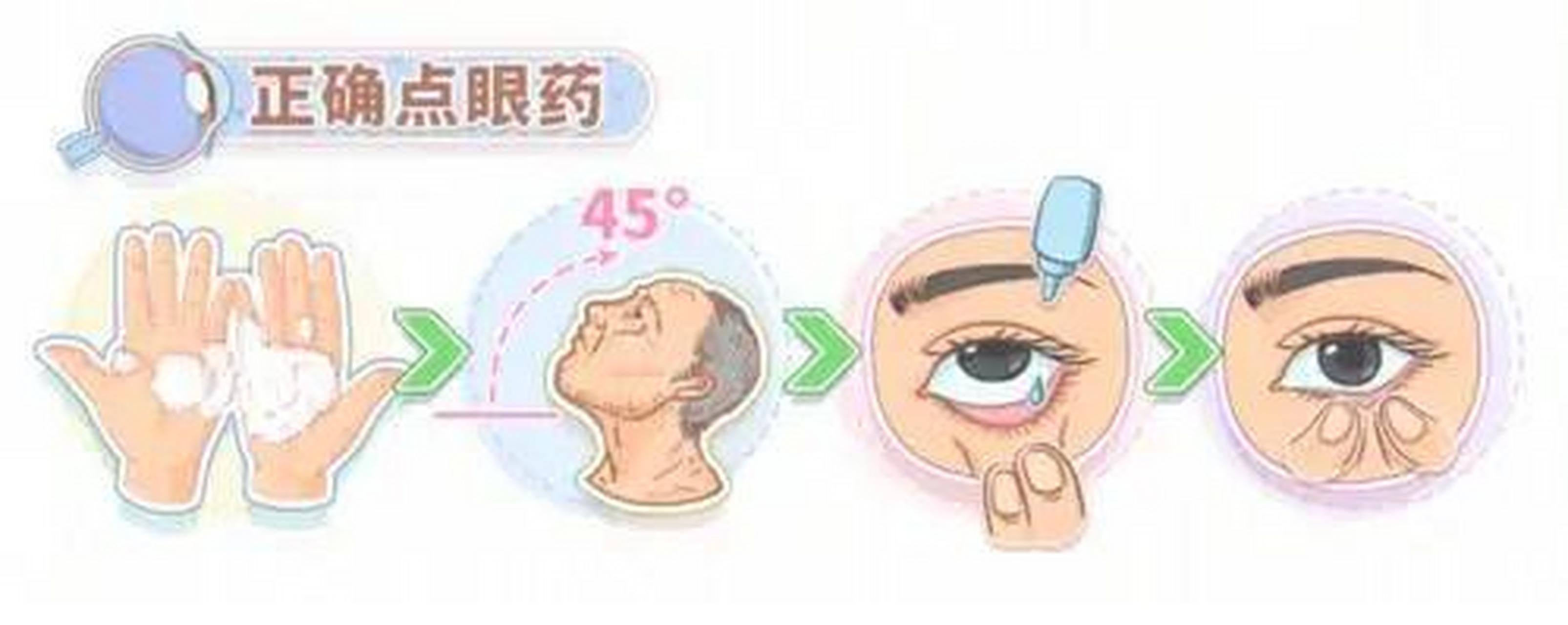 应该将眼药水滴入下眼睑,也可以点到下方的白眼球上.