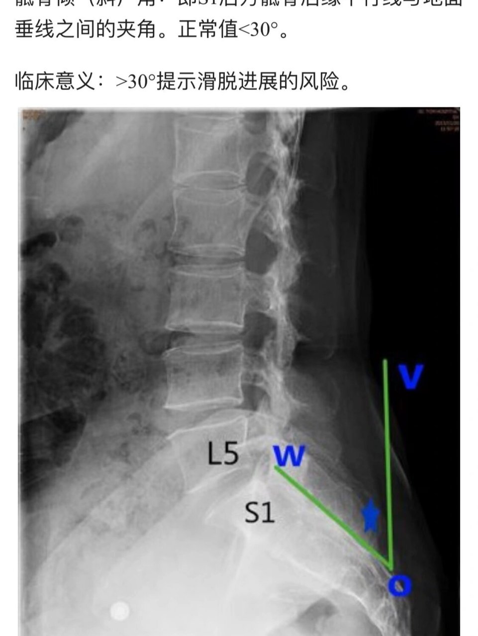 骶骨角和腰骶角不是一个概念.