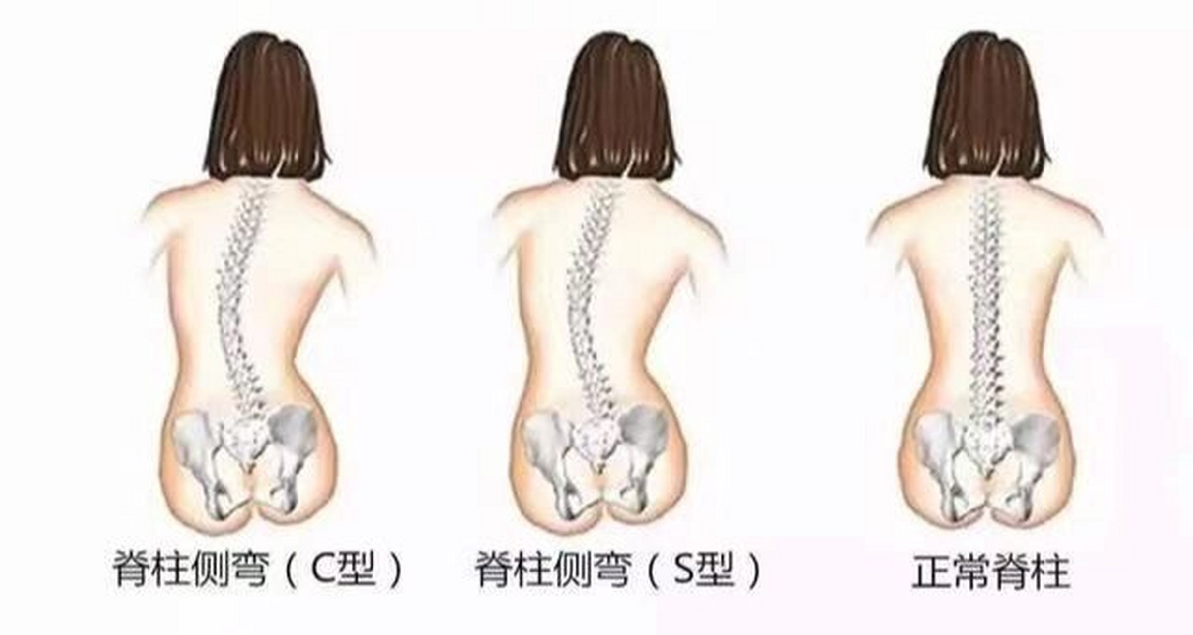 颈椎侧凸图片