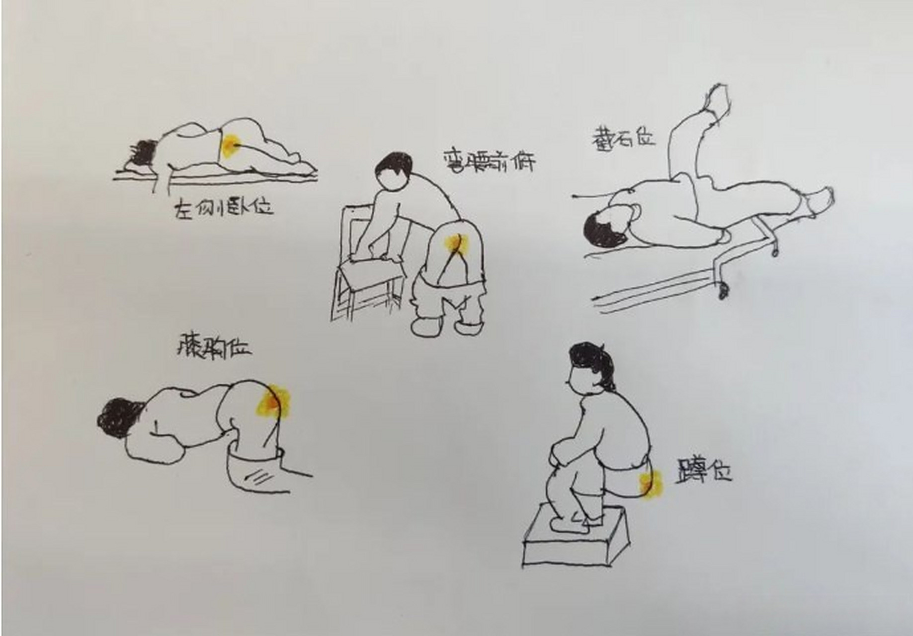 不要进行肛门指检了),这样的话检查的时候才能够充分的暴露直肠和肛门