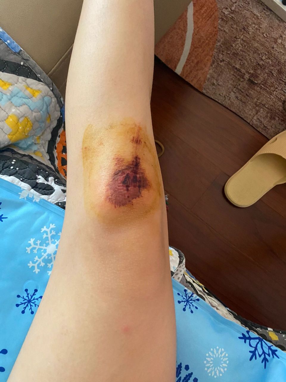 伤口结痂 今天,好像开始结痂了,更疼了