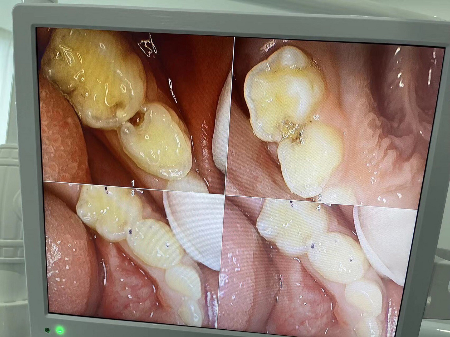 牙齿有洞要注意啦 不要小看这一个小洞,牙齿有洞也就是龋齿,常用的