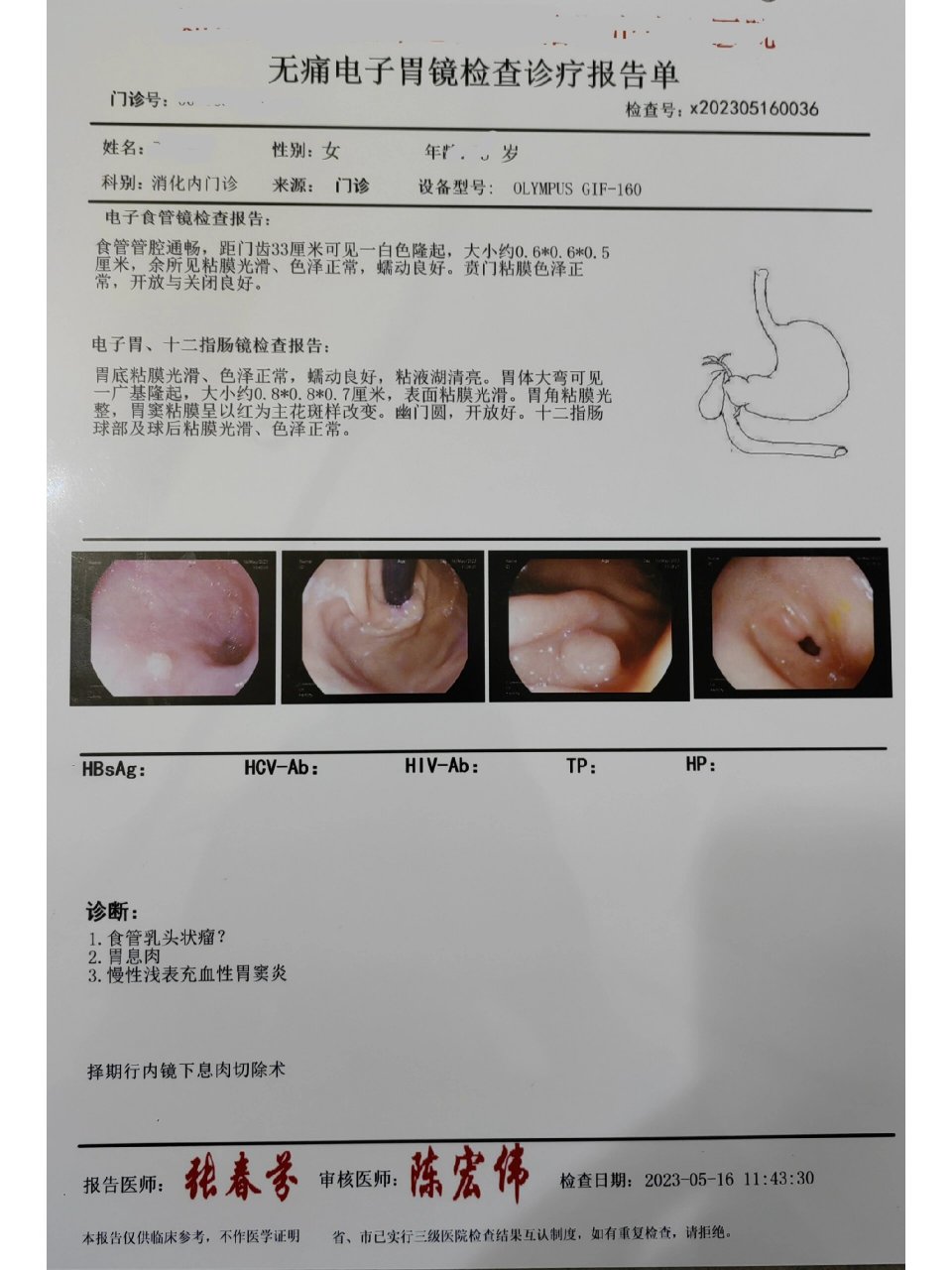 0.8cm有多大图片胃息肉图片