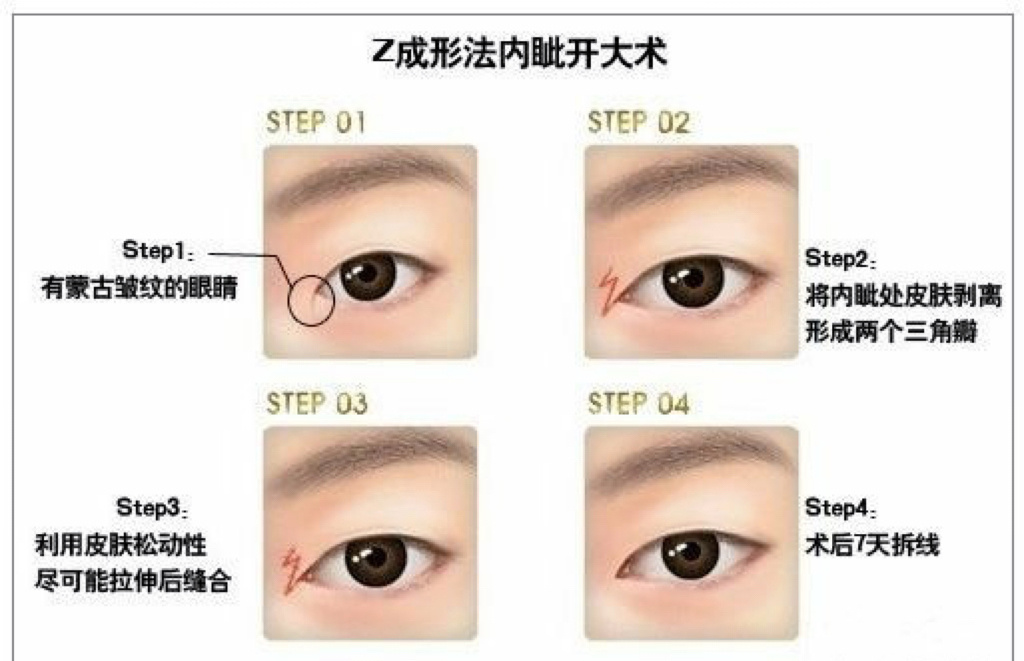 99697115科普|内眼角开过大6015等回缩90or修复90