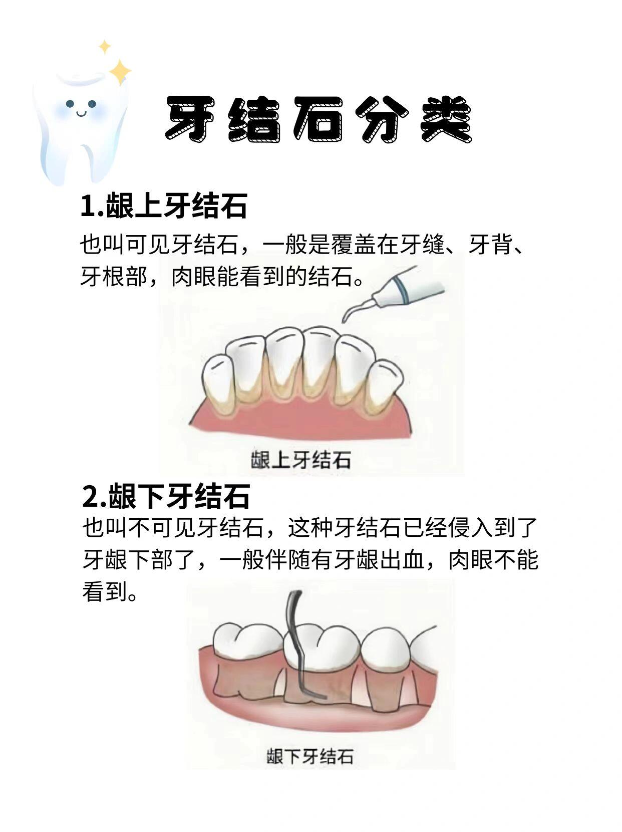 牙结石的分度图片图片