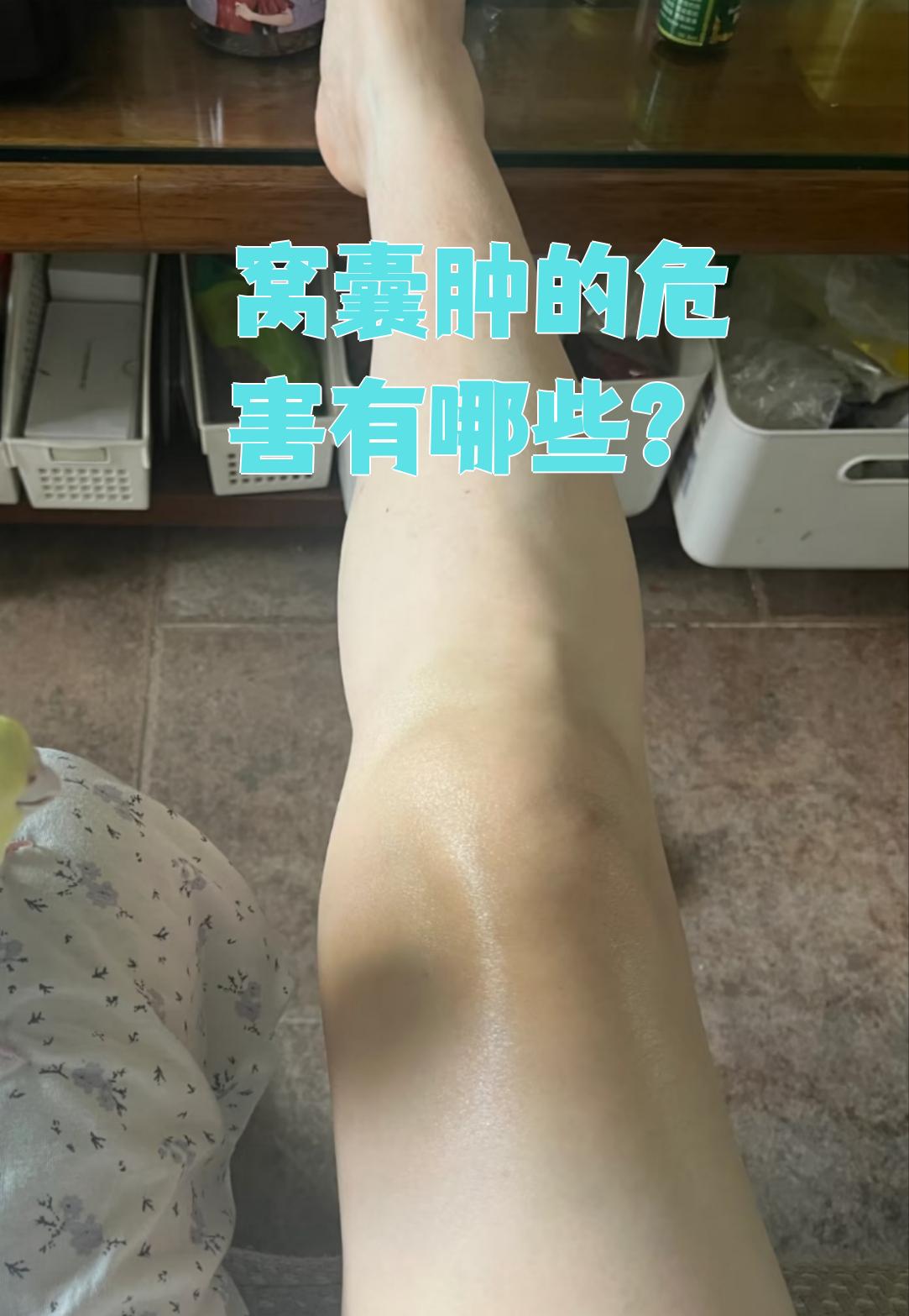 腘窝囊肿是膝关节后方滑囊肿大或滑膜囊向后突出的病变