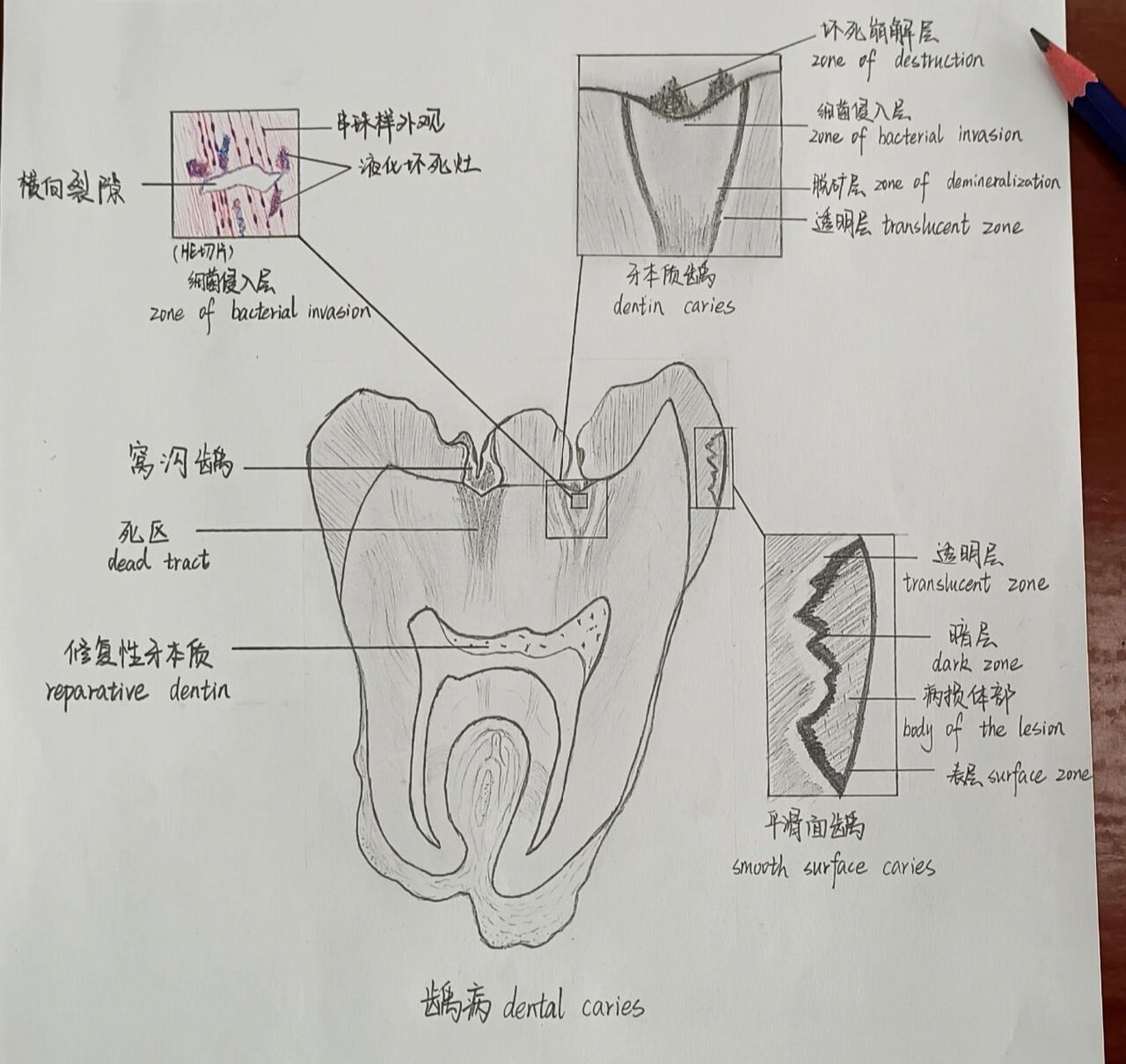口腔医学生又来做作业啦(3) 今天是龋病哦 牙釉质