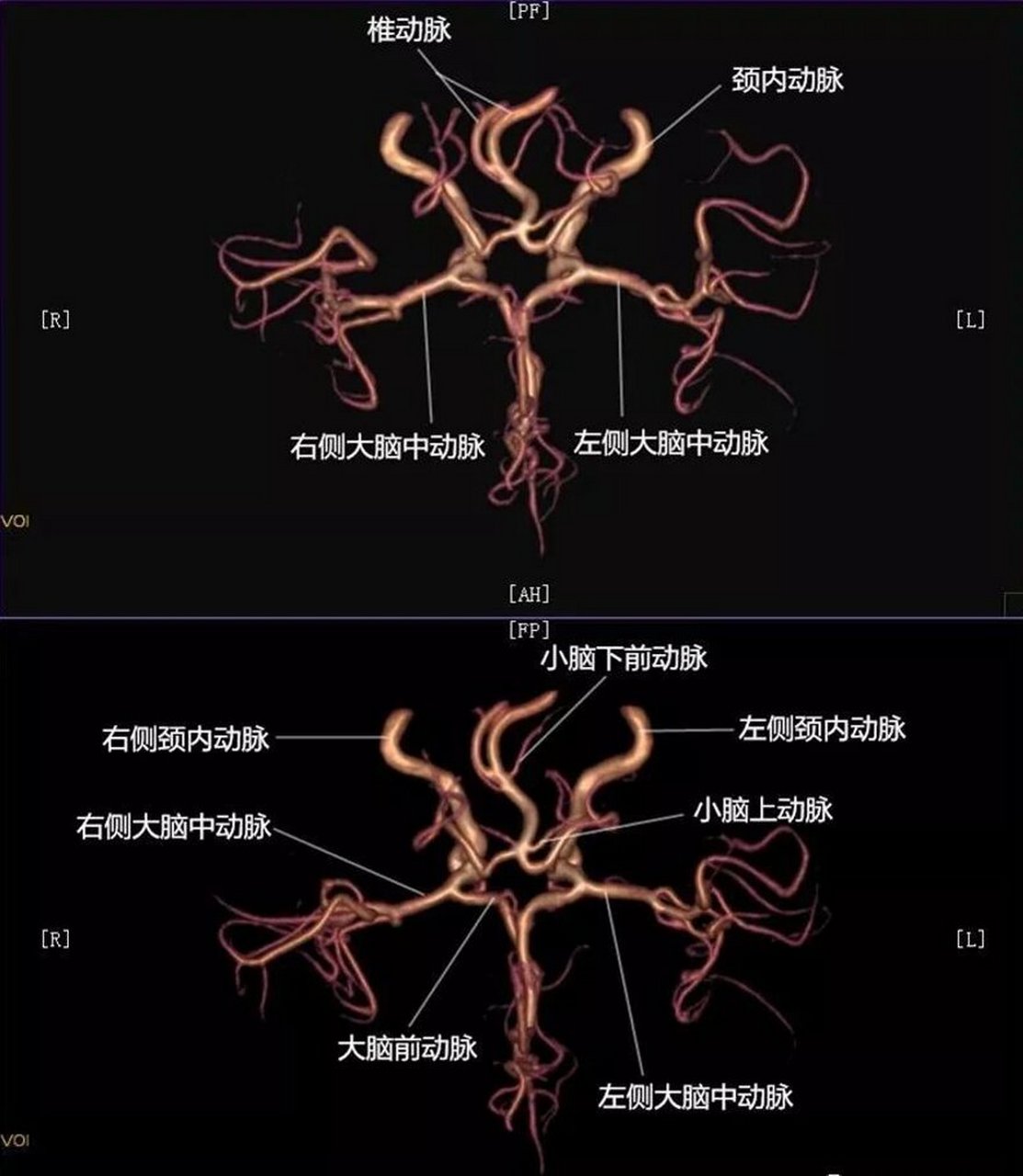 右侧大脑前动脉a1图片