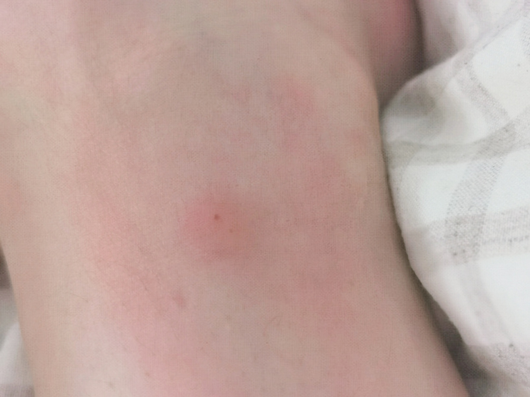 什么蚂蚁咬咬人又痒又肿?