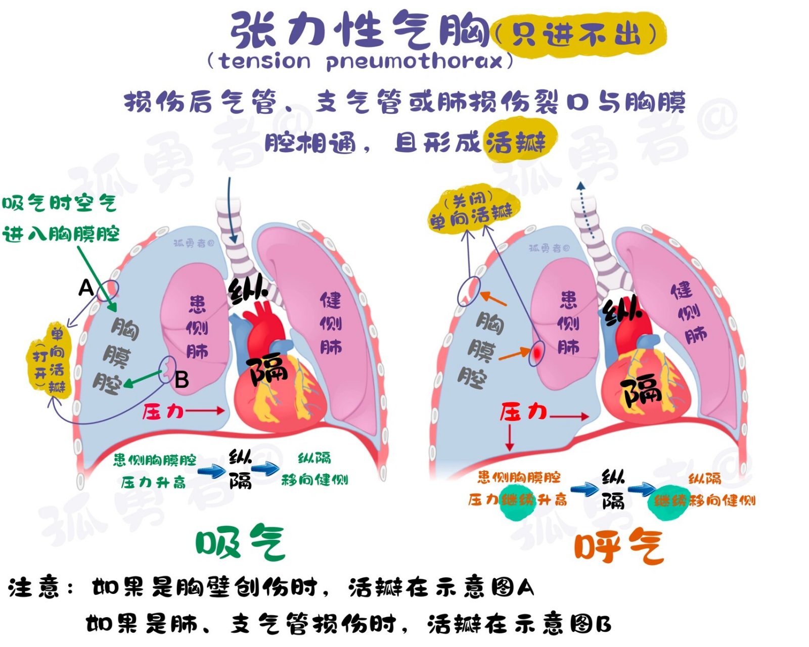 张力性气胸 1.