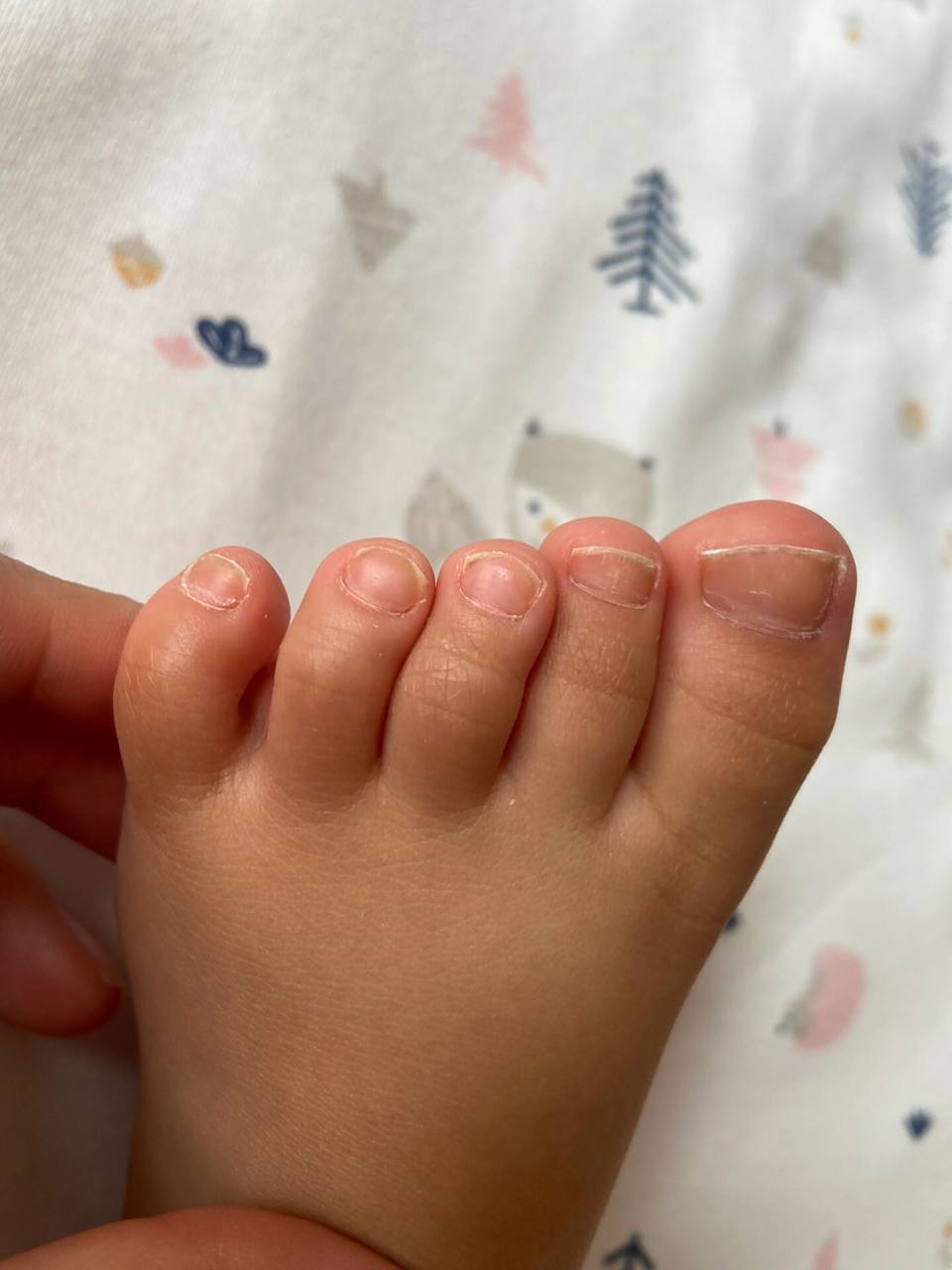 求解惑,宝宝指甲变厚 大约从宝宝7个月的时候开始觉得指甲越来越厚了