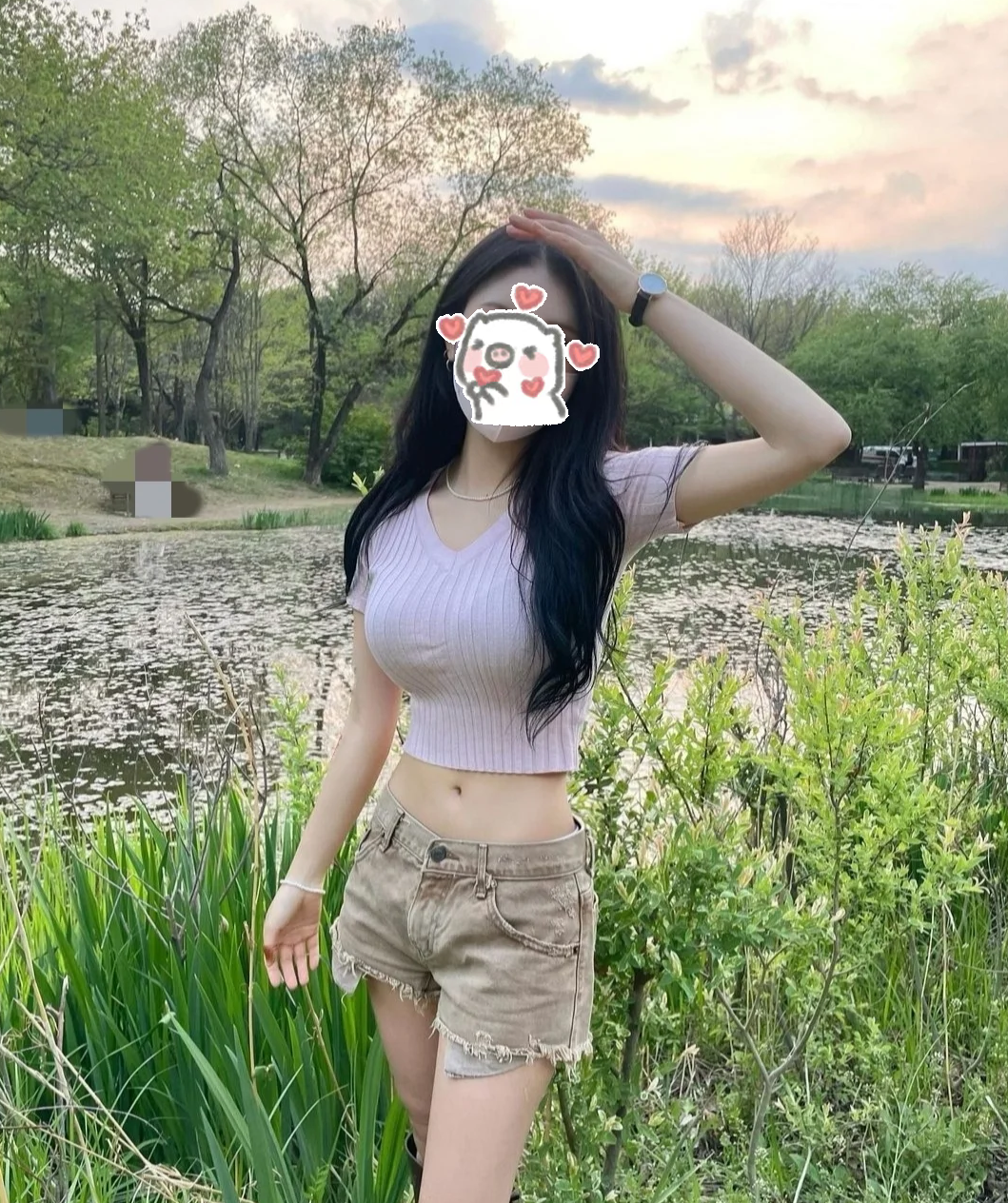 针对她的情况,我建议进行假体丰胸手术