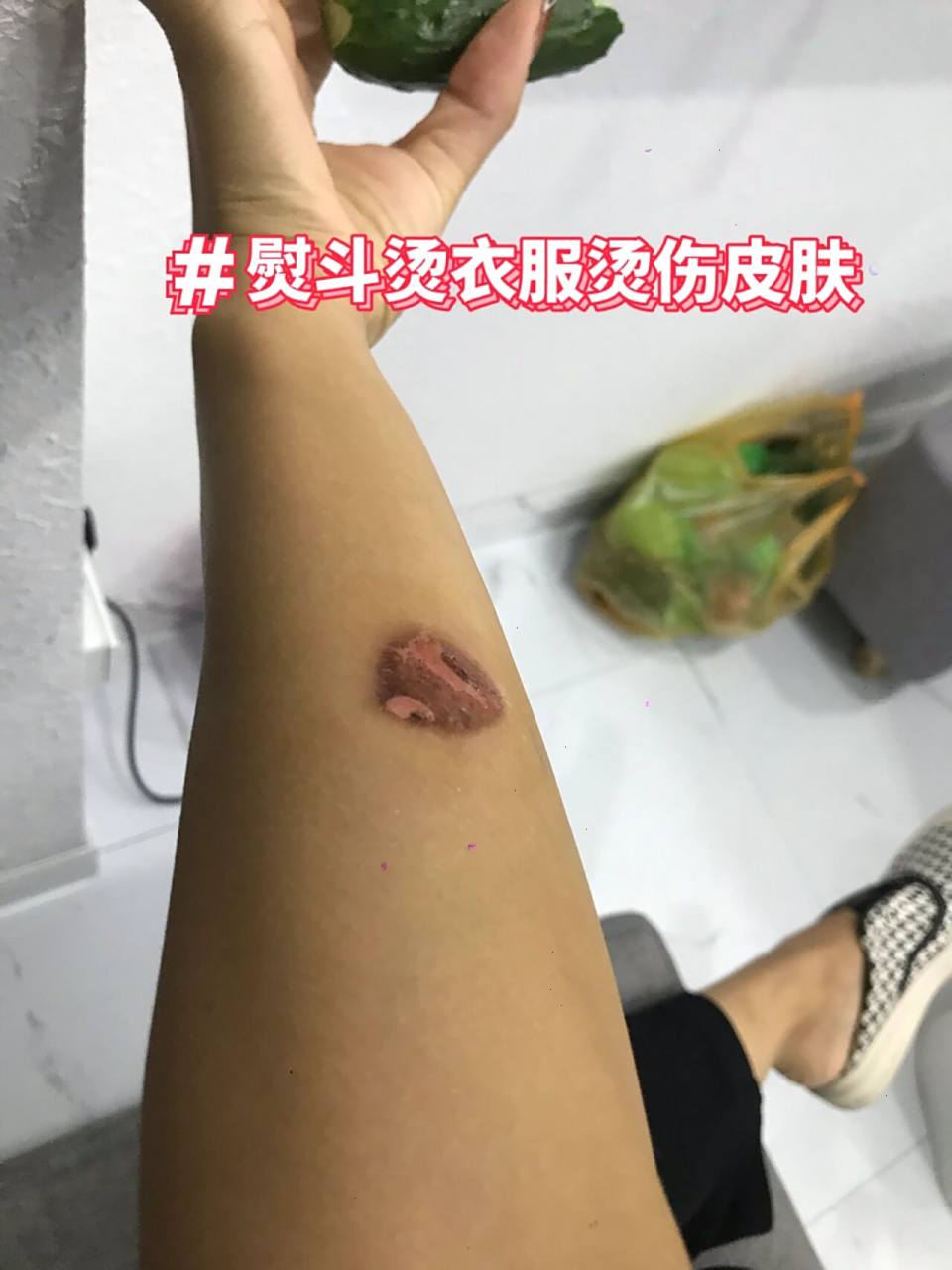 不小心被熨斗蒸汽烫伤 7.