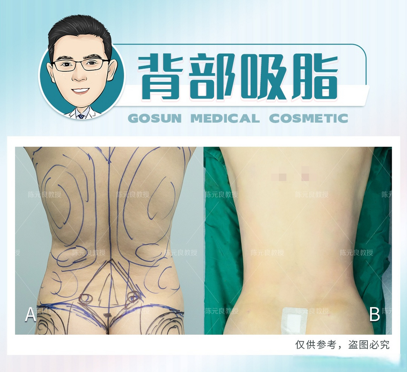 背部吸脂——打造薄薄一片腰吸脂超话 #后背吸脂